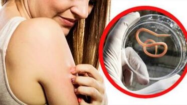 Un'eruzione cutanea sul corpo è un segno di un'infezione da elminti